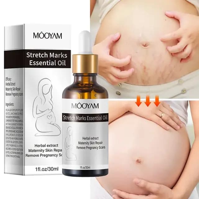 Stretch Marks Essential Oil – Advanced Stretch Mark & Scar Care